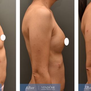 療程效果因人而異，上圖為A罩杯產後女性在做完自體脂肪隆乳之後​手術後一個月、手術後五個月成效